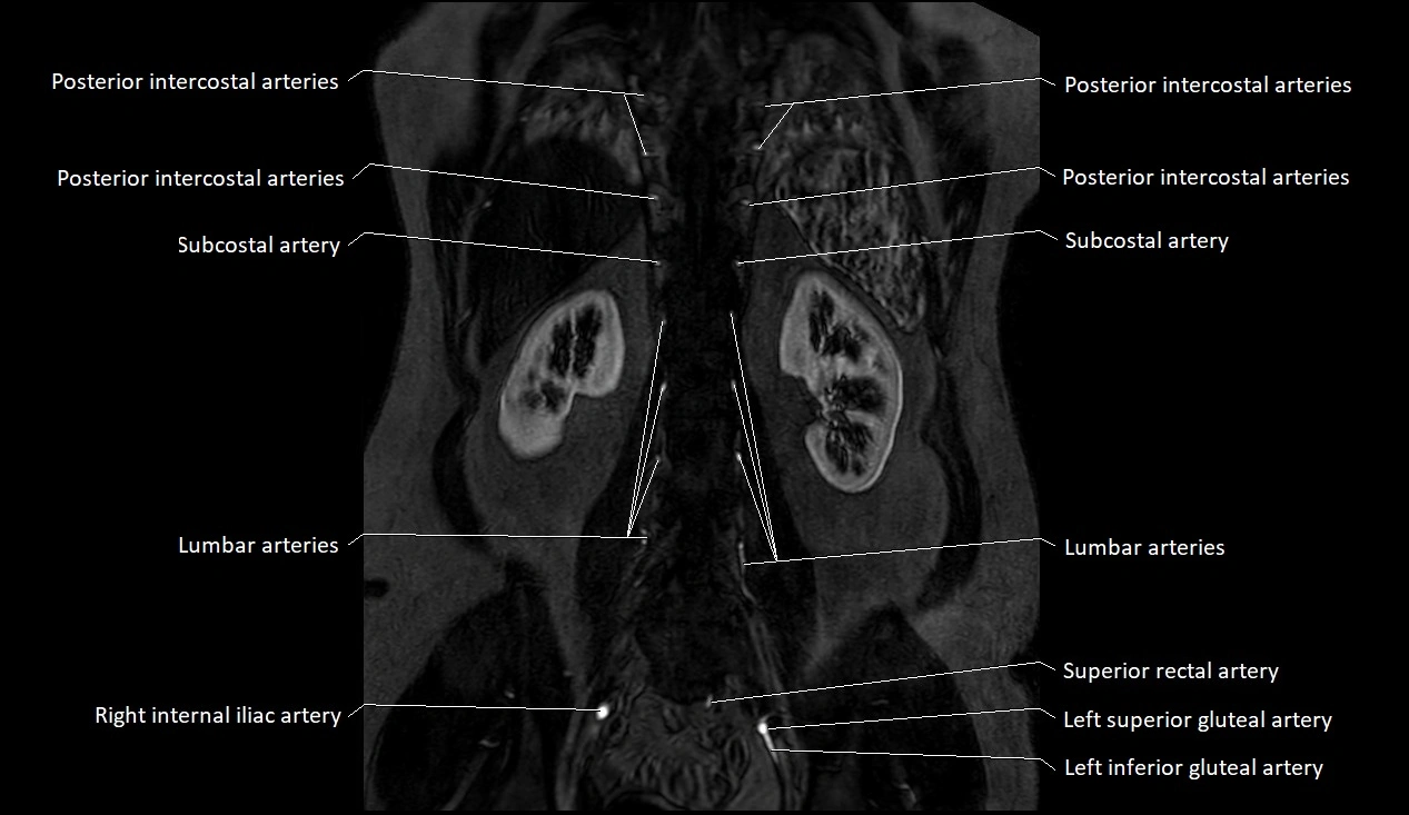 MRA Abdomen coronal anatomy image 46.webp